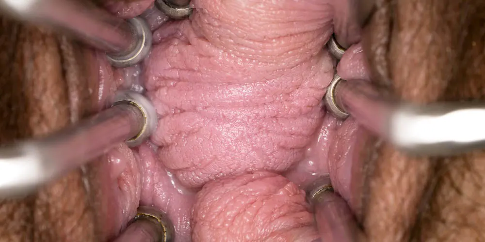 Vaginal Folds Everywhere